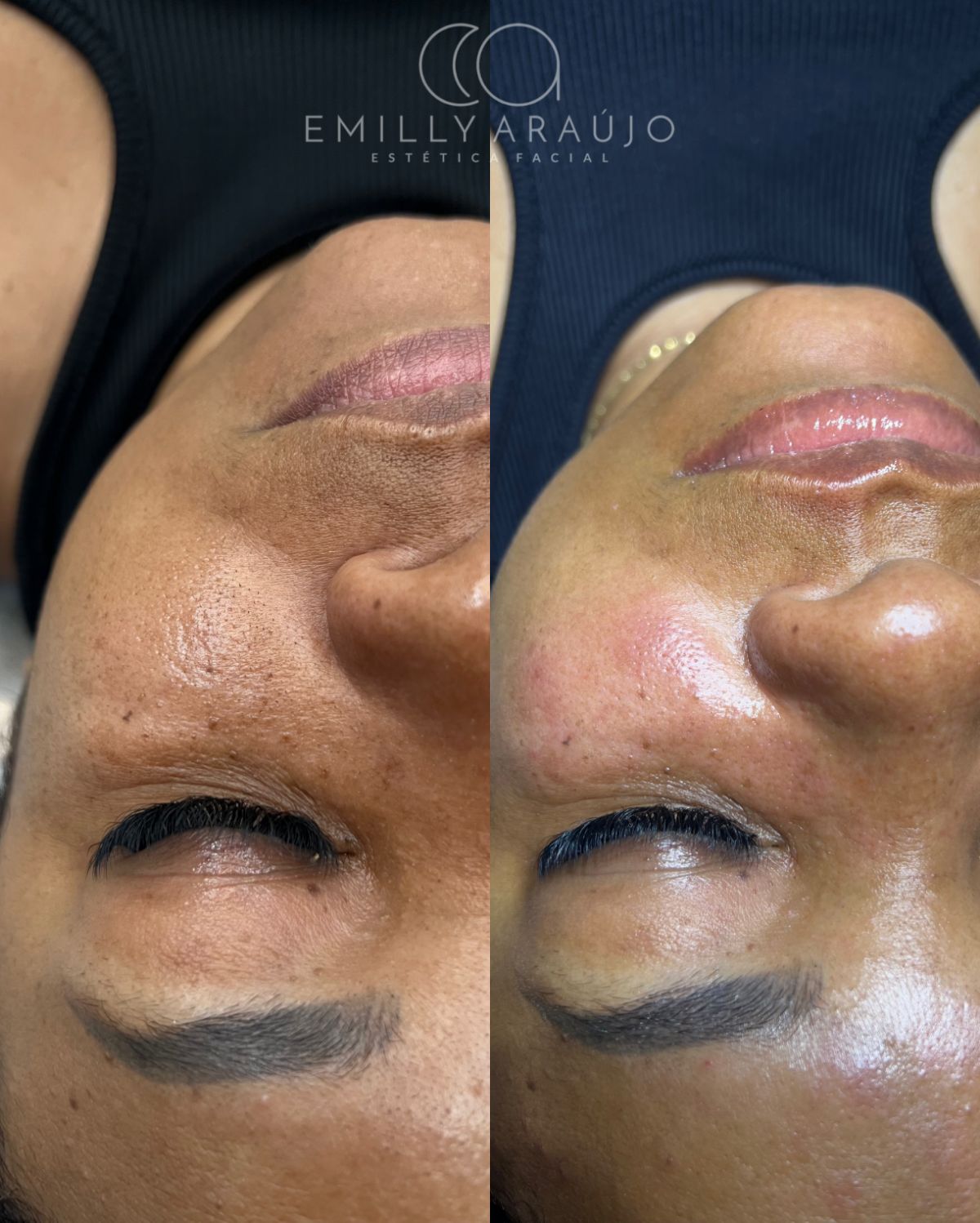 Antes e depois de limpeza de pele — remoção de cravos