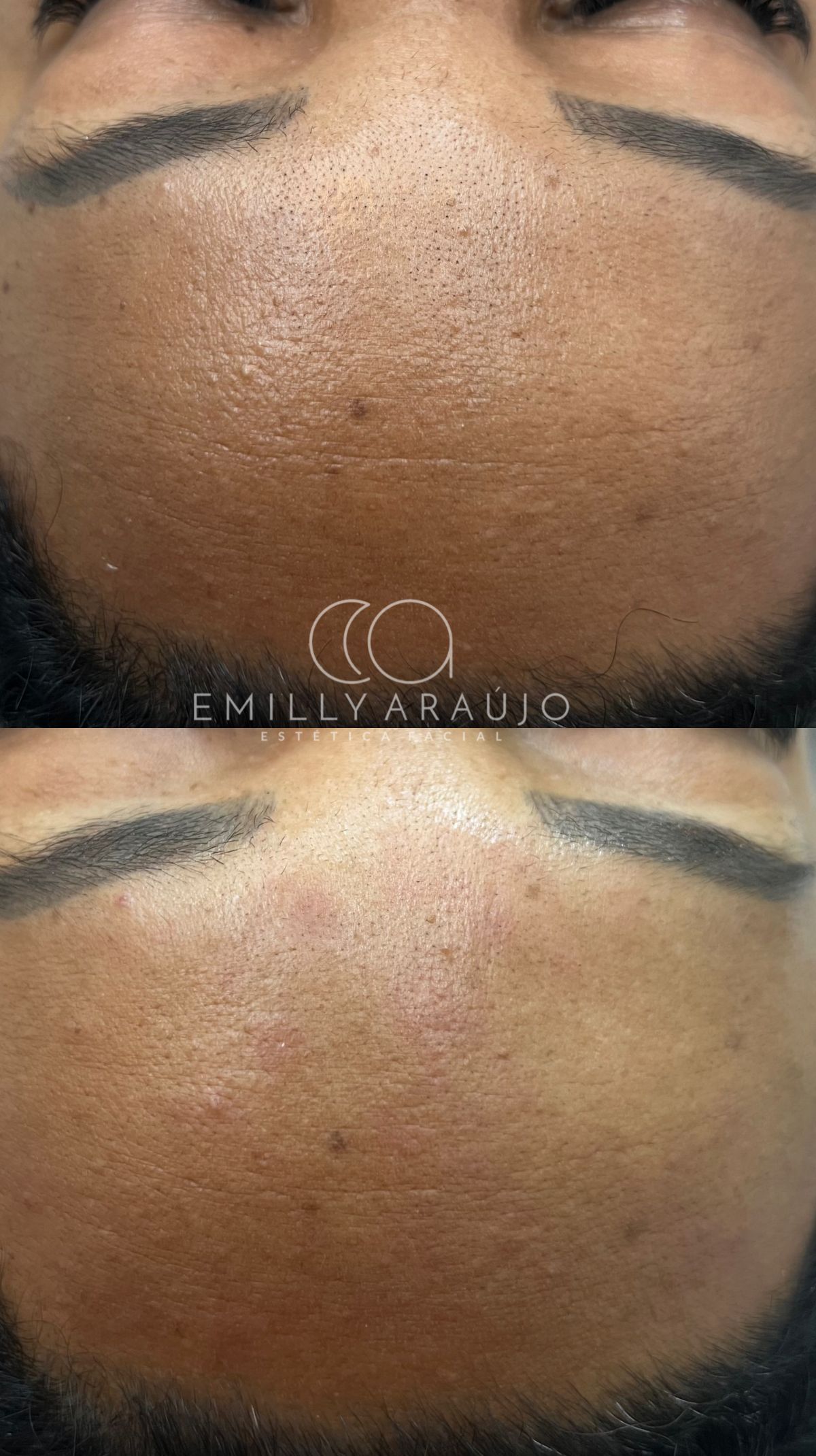 Antes e depois de limpeza de pele — hidratação