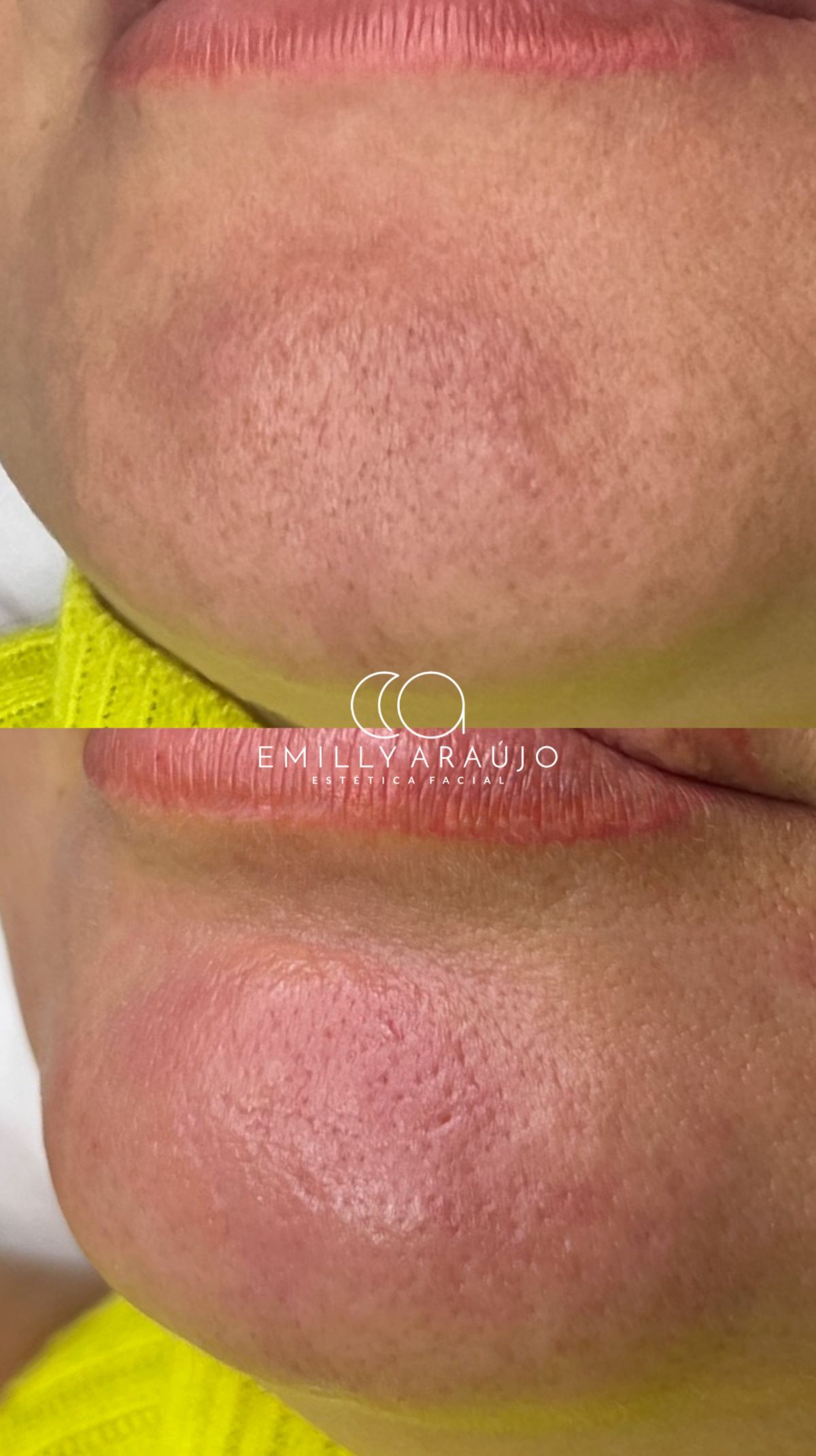 Antes e depois de limpeza de pele — efeito detox