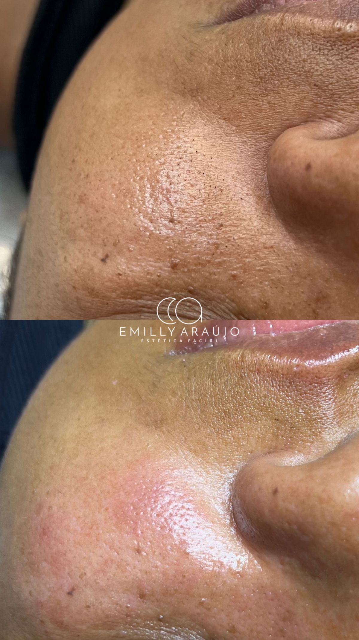 Antes e depois de limpeza de pele — poros refinados