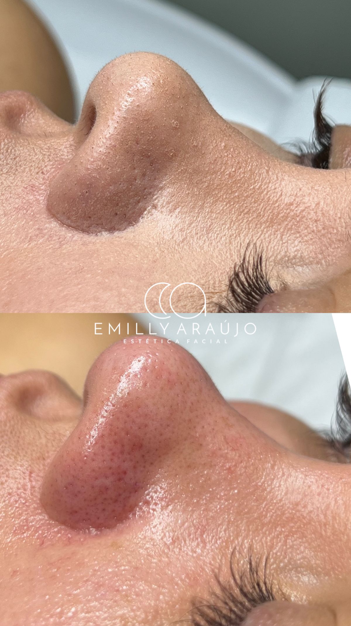 Antes e depois de limpeza de pele — cravos no nariz