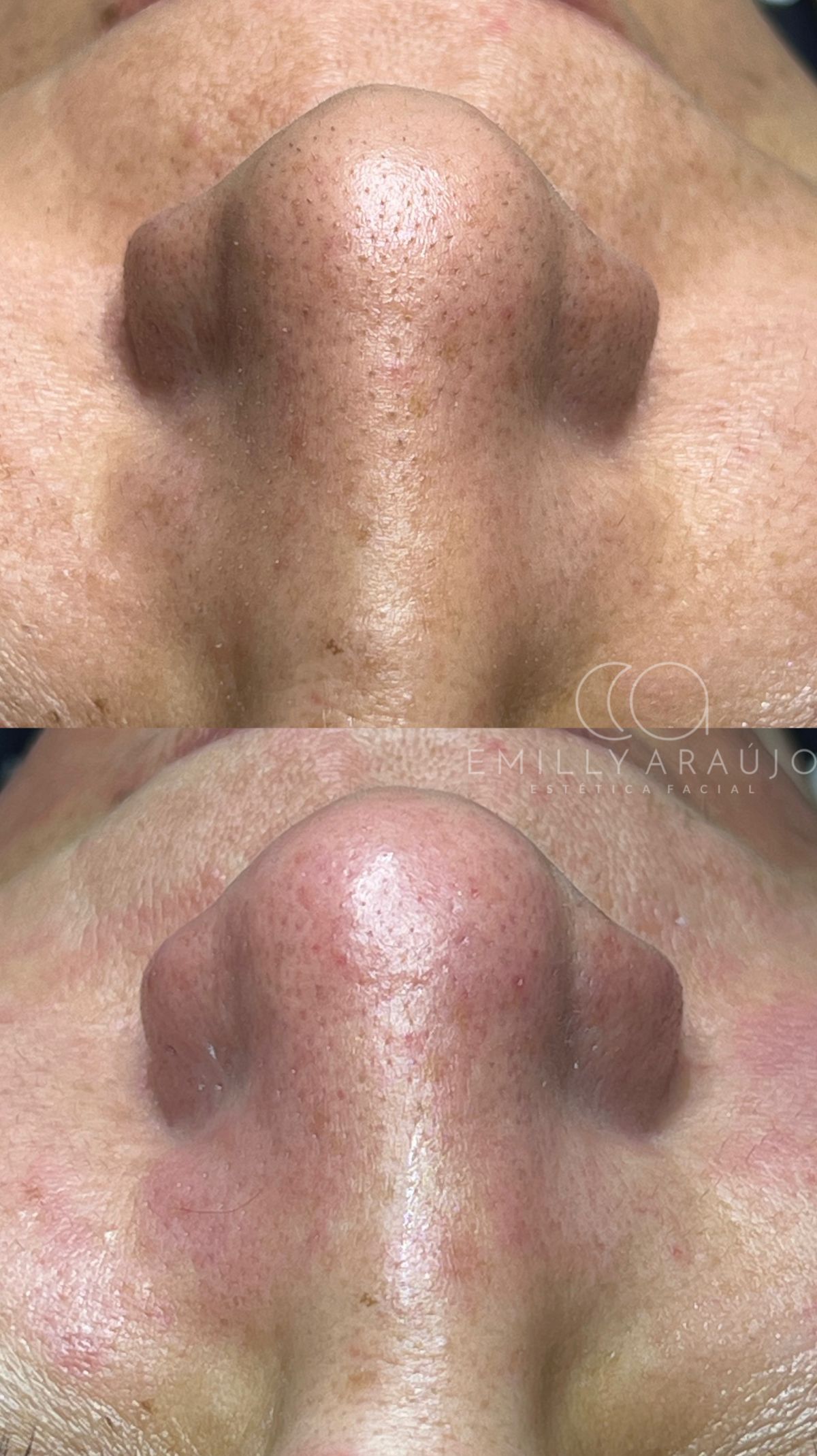 Antes e depois de limpeza de pele — textura da pele