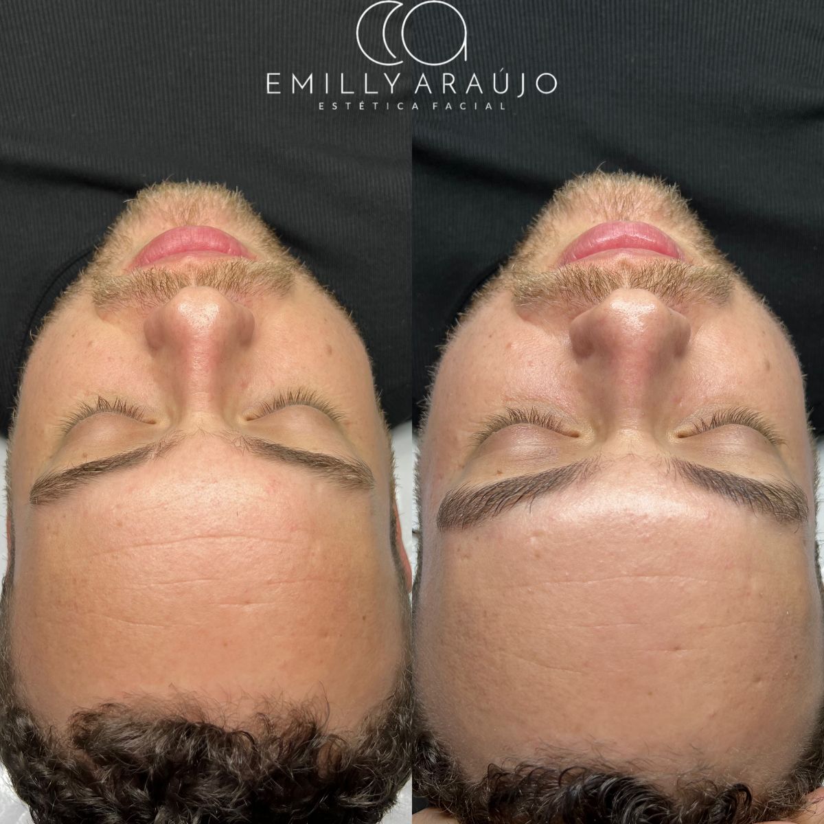 Antes e depois de limpeza de pele — viço e luminosidade