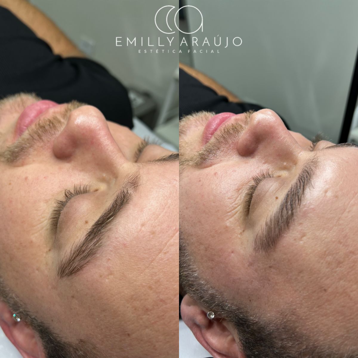 Antes e depois de limpeza de pele — pele saudável